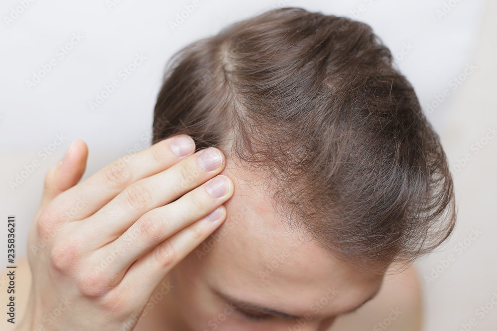 hairloss treatment